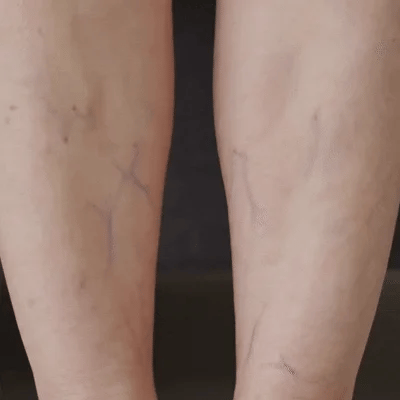 Fini les gonflements douloureux